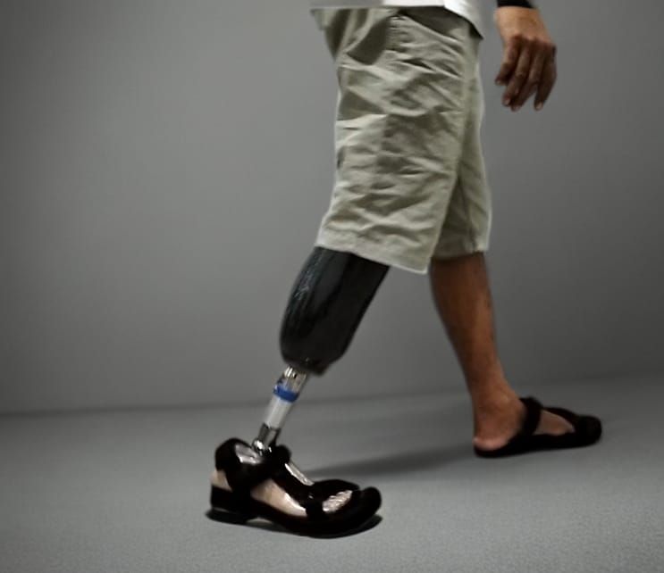 Below Knee Prosthesis 1