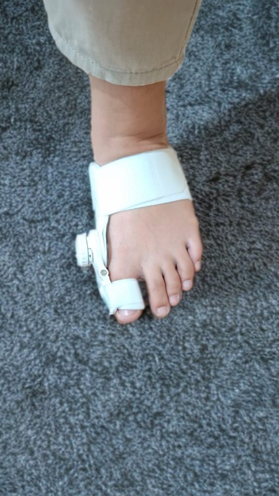 Bunion Splint 1