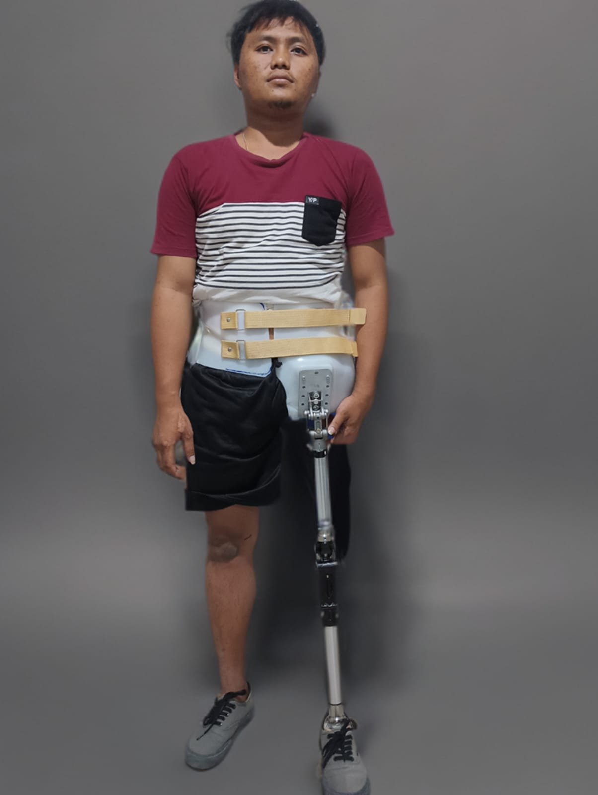 Hip Disarticulation Prothesis