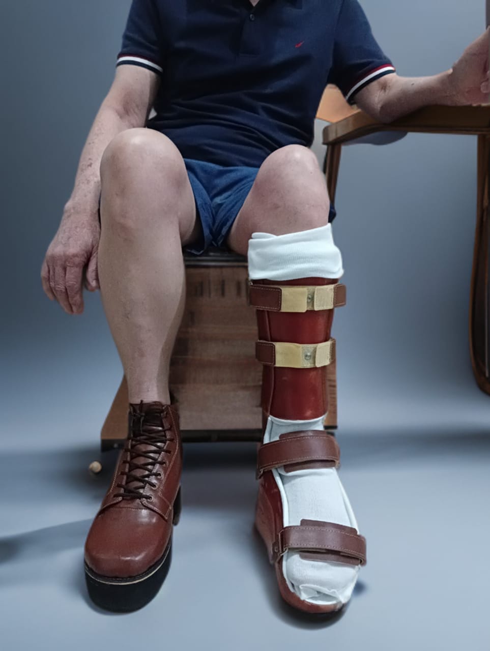 ABOVE KNEE PROSTESIS